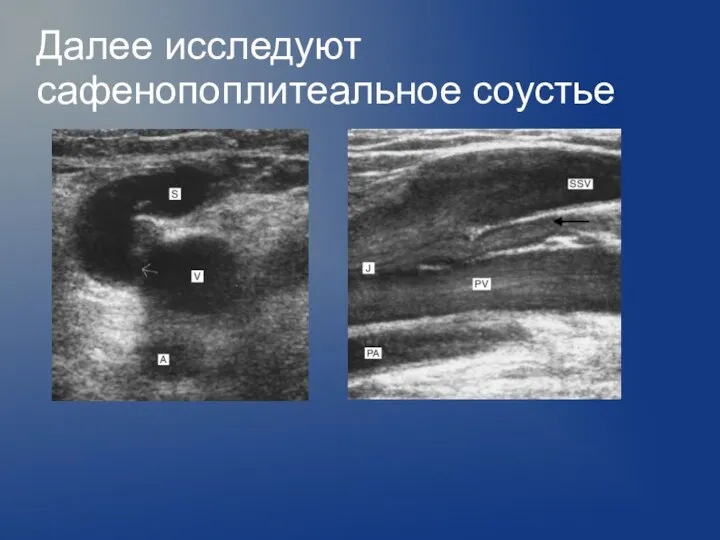 Далее исследуют сафенопоплитеальное соустье