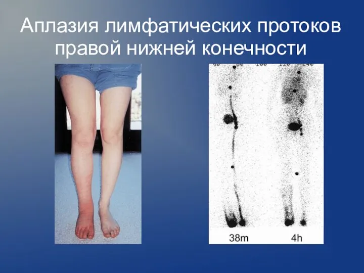 Аплазия лимфатических протоков правой нижней конечности