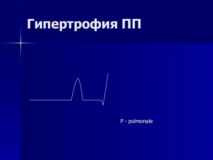 Гипертрофия ПП Р - pulmonale