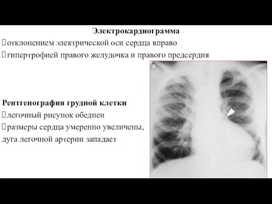 Электрокардиограмма отклонением электрической оси сердца вправо гипертрофией правого желудочка и правого предсердия Рентгенография