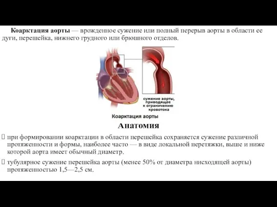 Коарктация аорты — врожденное сужение или полный перерыв аорты в области ее дуги,