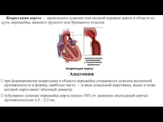 Коарктация аорты — врожденное сужение или полный перерыв аорты в