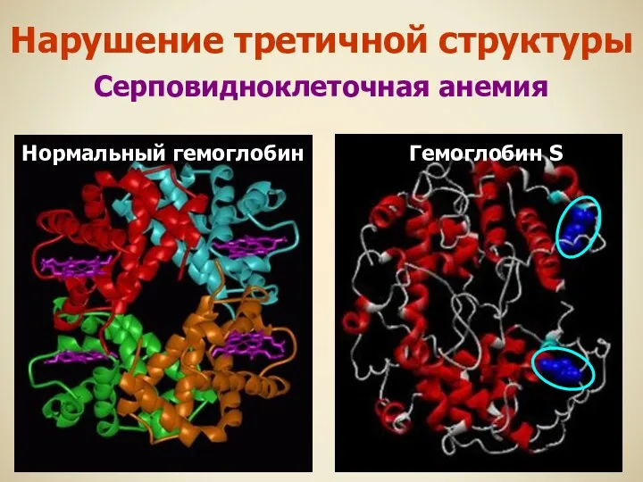 Нормальный гемоглобин Гемоглобин S Нарушение третичной структуры Серповидноклеточная анемия