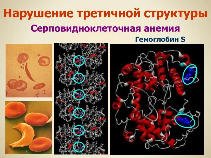 Гемоглобин S Нарушение третичной структуры Серповидноклеточная анемия