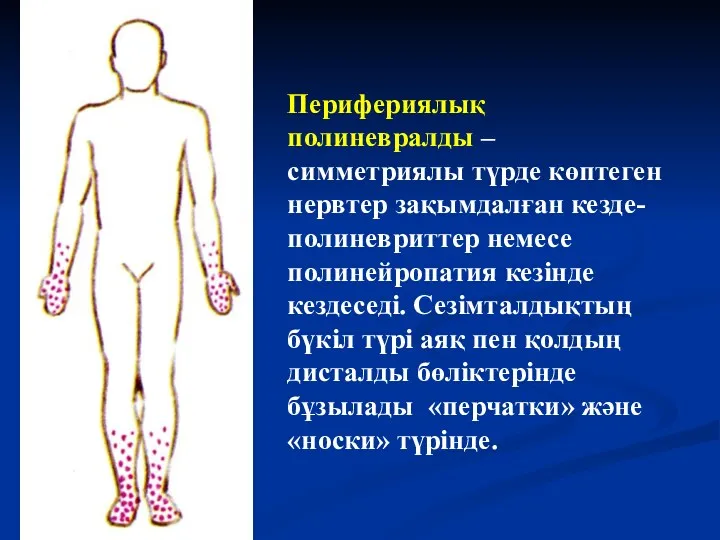 Перифериялық полиневралды – симметриялы түрде көптеген нервтер зақымдалған кезде-полиневриттер немесе