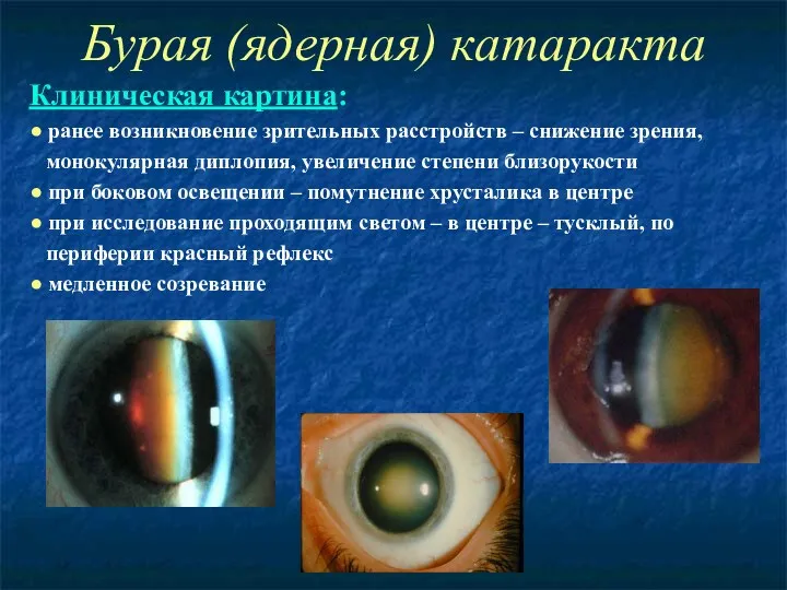 Бурая (ядерная) катаракта Клиническая картина: ● ранее возникновение зрительных расстройств