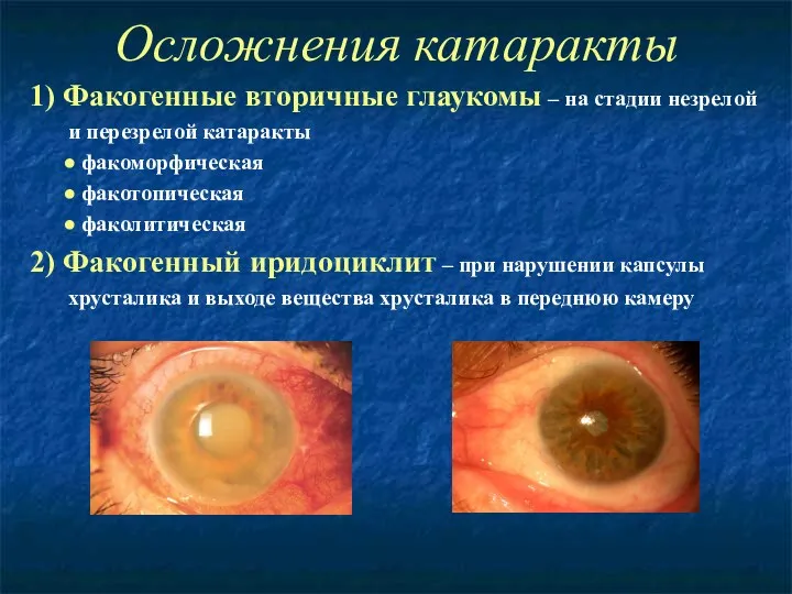 Осложнения катаракты 1) Факогенные вторичные глаукомы – на стадии незрелой