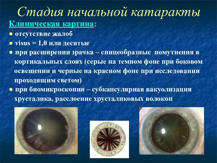 Стадия начальной катаракты Клиническая картина: ● отсутствие жалоб ● visus