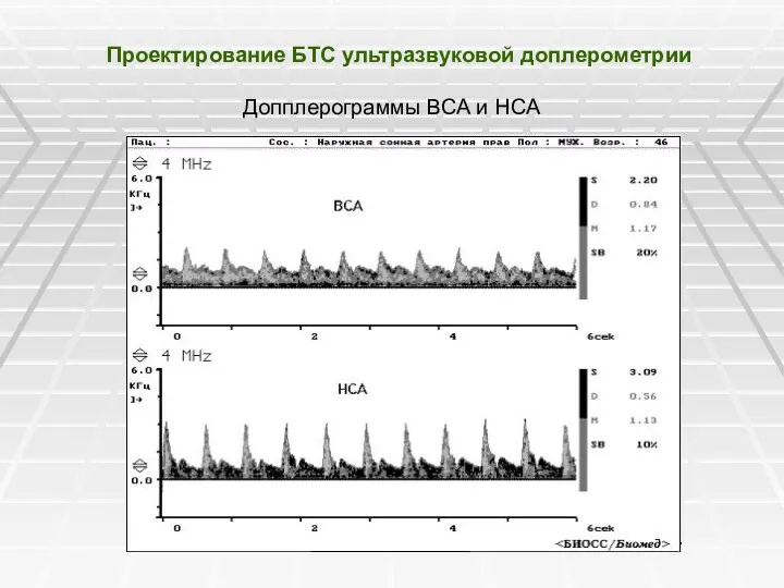 Проектирование БТС ультразвуковой доплерометрии Допплерограммы ВСА и НСА