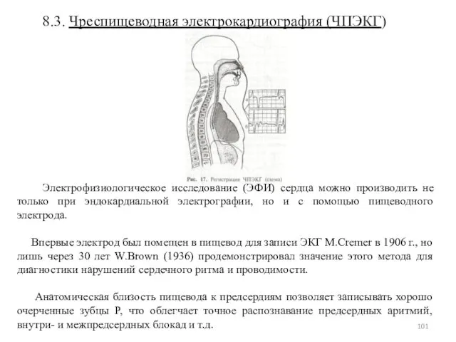 8.3. Чреспищеводная электрокардиография (ЧПЭКГ) Электрофизиологическое исследование (ЭФИ) сердца можно производить