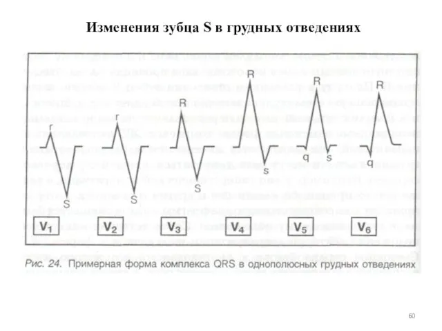 Изменения зубца S в грудных отведениях