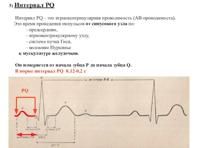 3) Интервал PQ Интервал PQ – это атриовентрикулярная проводимость (АВ-проводимость).