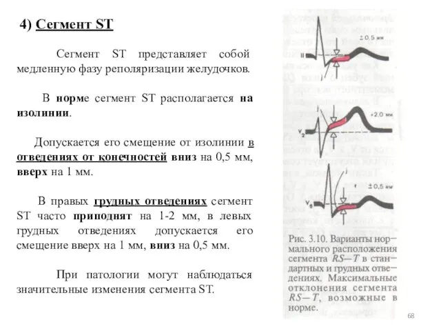 4) Сегмент ST Сегмент ST представляет собой медленную фазу реполяризации