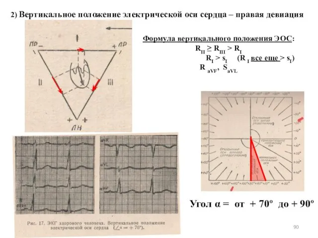 2) Вертикальное положение электрической оси сердца – правая девиация Формула