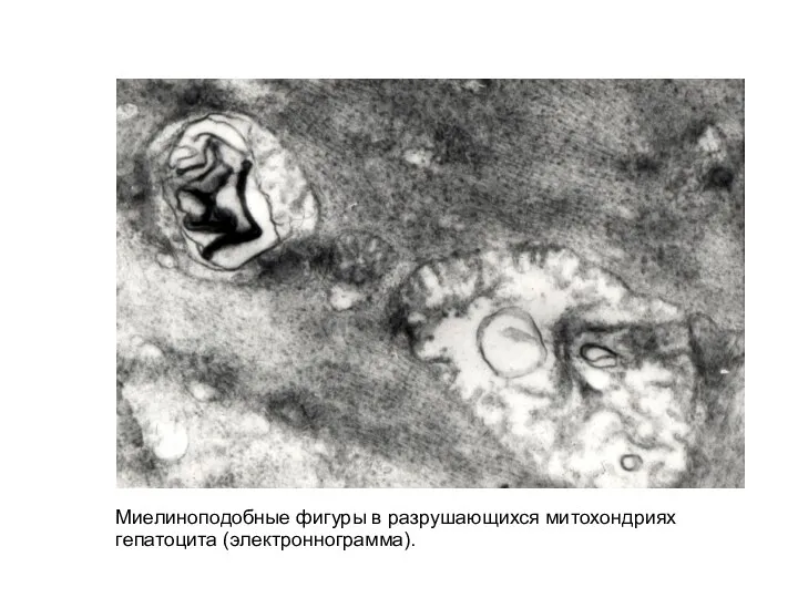 Миелиноподобные фигуры в разрушающихся митохондриях гепатоцита (электроннограмма).