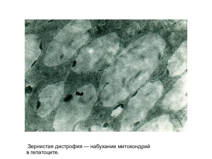 Зернистая дистрофия — набухание митохондрий в гепатоците.