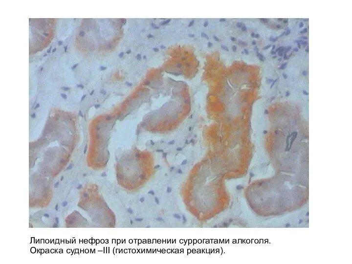Липоидный нефроз при отравлении суррогатами алкоголя. Окраска судном –III (гистохимическая реакция).