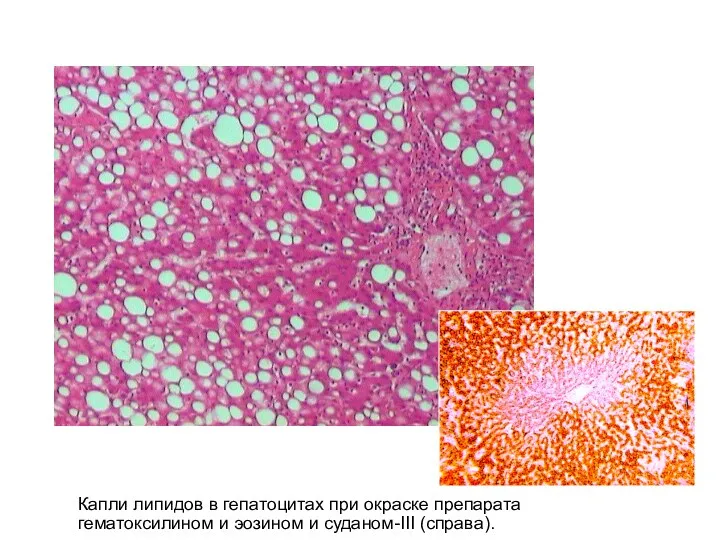 Капли липидов в гепатоцитах при окраске препарата гематоксилином и эозином и суданом-III (справа).