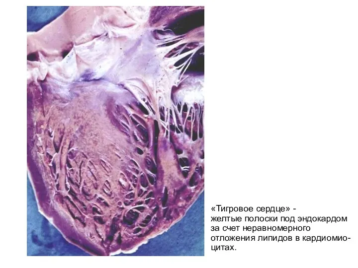 «Тигровое сердце» - желтые полоски под эндокардом за счет неравномерного отложения липидов в кардиомио- цитах.