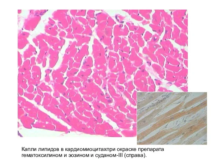 Капли липидов в кардиомиоцитахпри окраске препарата гематоксилином и эозином и суданом-III (справа). .