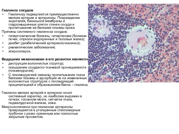 Гиалиноз сосудов Гиалинозу подвергаются преимущественно мелкие артерии и артериолы. Повреждение