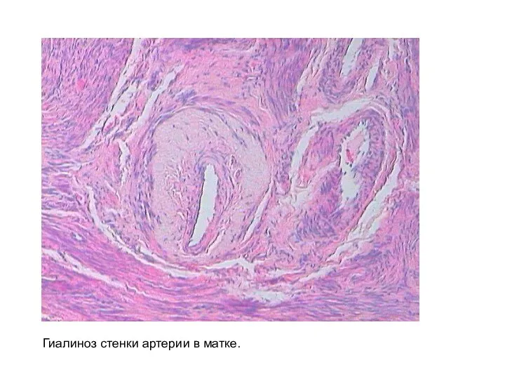 Гиалиноз стенки артерии в матке.
