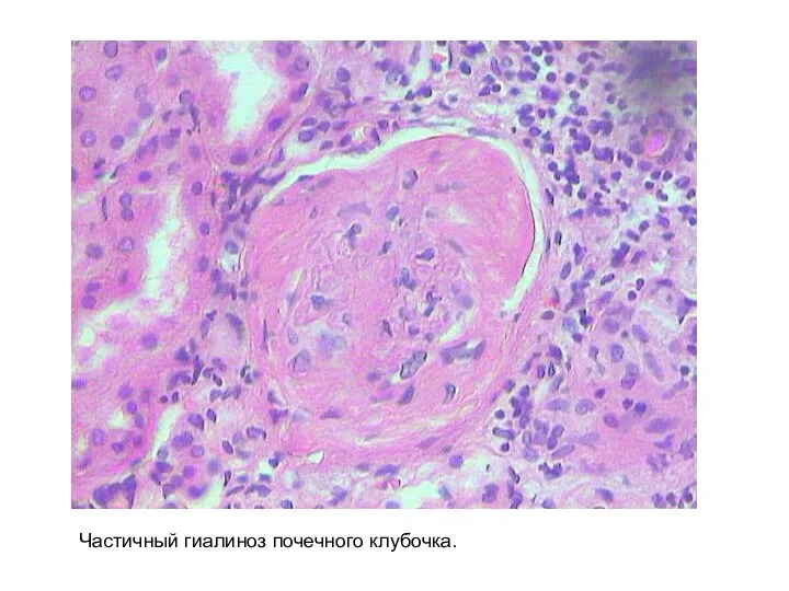 Частичный гиалиноз почечного клубочка.