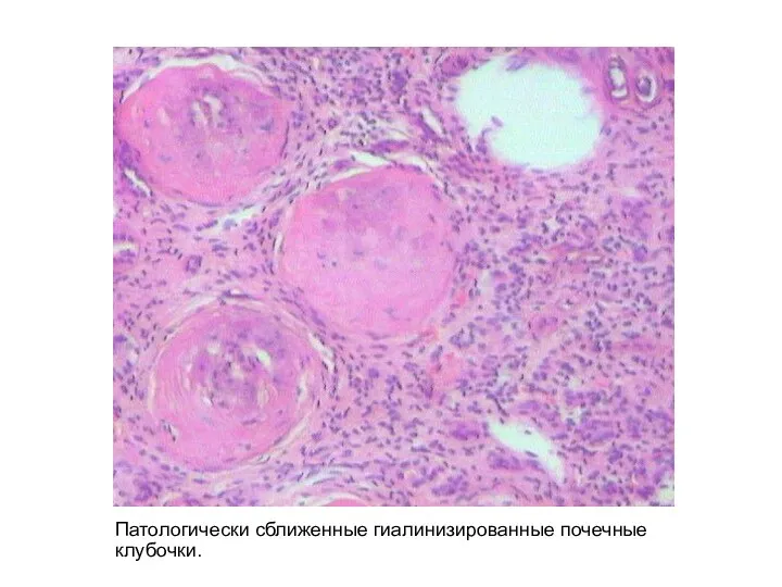 Патологически сближенные гиалинизированные почечные клубочки.