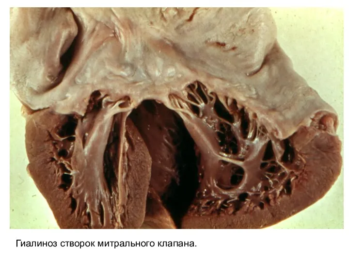 Гиалиноз створок митрального клапана.