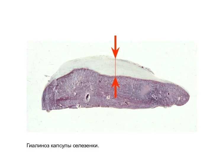 Гиалиноз капсулы селезенки.