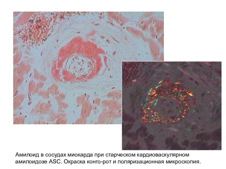Амилоид в сосудах миокарда при старческом кардиоваскулярном амилоидозе ASC. Окраска конго-рот и поляризационная микроскопия.