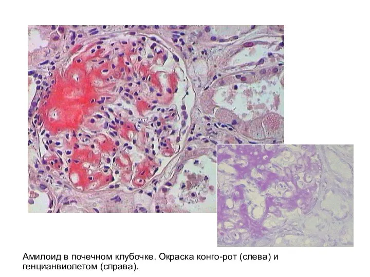 Амилоид в почечном клубочке. Окраска конго-рот (слева) и генцианвиолетом (справа).