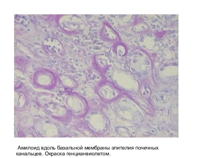 Амилоид вдоль базальной мембраны эпителия почечных канальцев. Окраска генцианвиолетом.