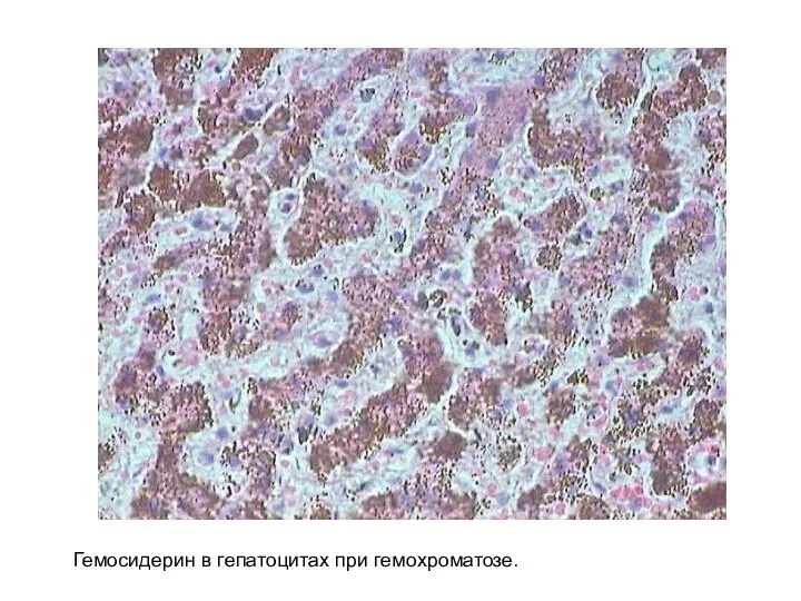 Гемосидерин в гепатоцитах при гемохроматозе.