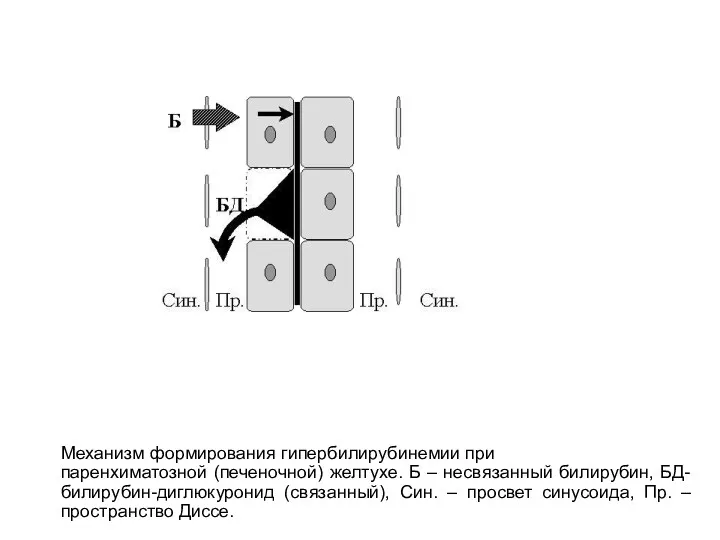 Механизм формирования гипербилирубинемии при паренхиматозной (печеночной) желтухе. Б – несвязанный билирубин, БД- билирубин-диглюкуронид