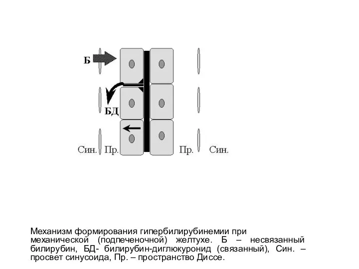 Механизм формирования гипербилирубинемии при механической (подпеченочной) желтухе. Б – несвязанный билирубин, БД- билирубин-диглюкуронид
