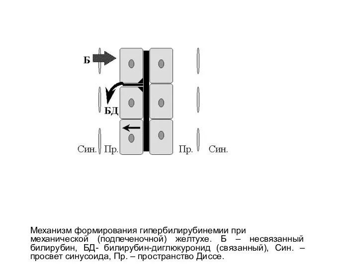 Механизм формирования гипербилирубинемии при механической (подпеченочной) желтухе. Б – несвязанный