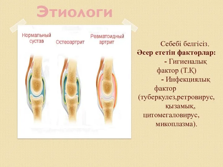 Этиология Себебі белгісіз. Әсер ететін факторлар: - Гигиеналық фактор (Т.Қ)