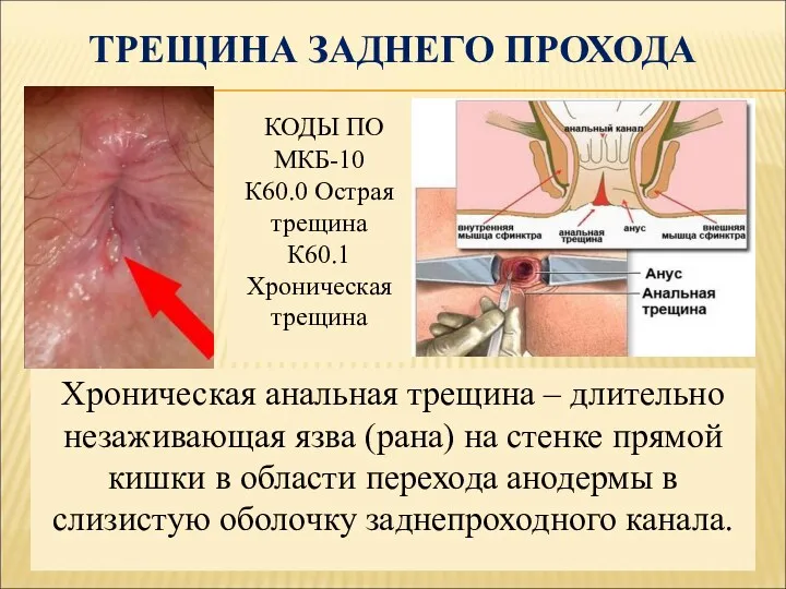 ТРЕЩИНА ЗАДНЕГО ПРОХОДА Хроническая анальная трещина – длительно незаживающая язва