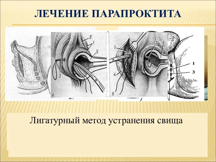 ЛЕЧЕНИЕ ПАРАПРОКТИТА Операция Габриеля – иссечение свища в просвет кишки