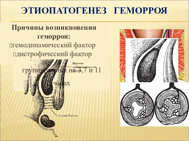 ЭТИОПАТОГЕНЕЗ ГЕМОРРОЯ Кавернозные тельца закладываются на 3-8 неделе эмбрионального развития,