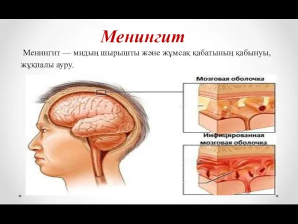 Менингит Менингит — мидың шырышты және жұмсақ қабатының қабынуы, жұқпалы ауру.