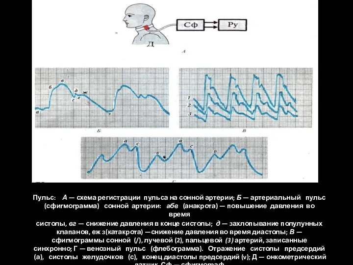 Пульс: А — схема регистрации пульса на сонной артерии; Б