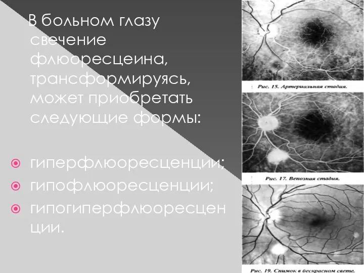 В больном глазу свечение флюоресцеина, трансформируясь, может приобретать следующие формы: гиперфлюоресценции; гипофлюоресценции; гипогиперфлюоресценции.