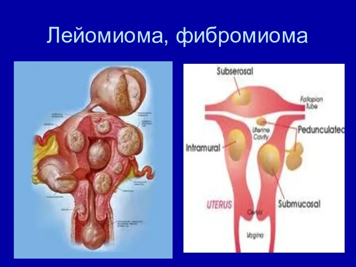 Лейомиома, фибромиома