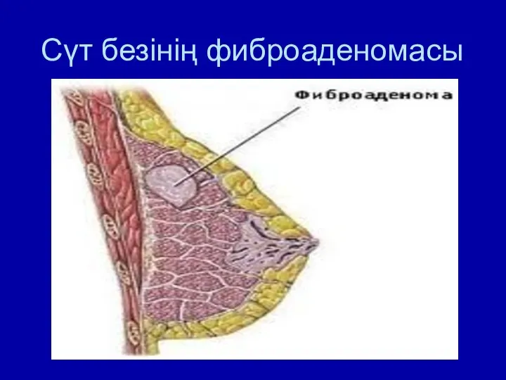 Сүт безінің фиброаденомасы