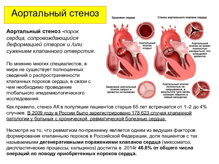 Аортальный стеноз Аортальный стеноз -порок сердца, сопровождающийся деформацией створок и