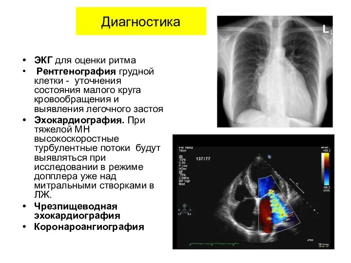 Диагностика ЭКГ для оценки ритма Рентгенография грудной клетки - уточнения