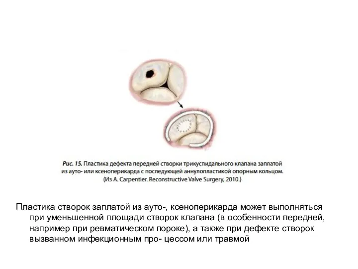 Пластика створок заплатой из ауто-, ксеноперикарда может выполняться при уменьшенной