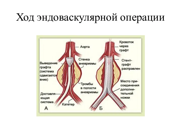 Ход эндоваскулярной операции